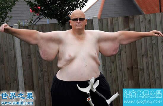 世界上最胖的人减掉500斤肉，皮肤下垂吓死人