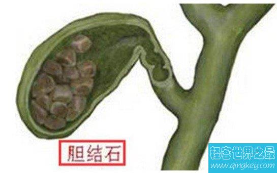 世界上最大的人体胆结石，重达12.58千克