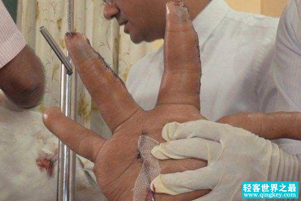 世界上最大的手指:食指长达30厘米(相当于成年人小臂)