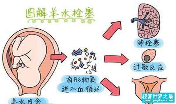 羊水栓塞是什么?羊水栓塞主要原因是什么(80%死亡率)