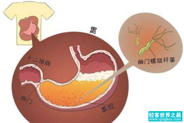 什么是幽门螺旋杆菌：能在胃中生存的细菌(引发胃炎等)