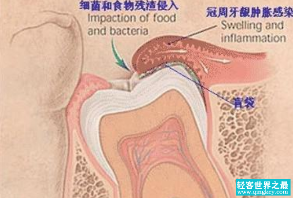 智齿从哪里长出来的：牙弓最靠里的位置(成年后生长)