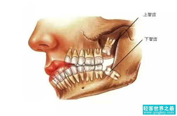 智齿是哪个牙齿：第三磨牙(大部分智齿需拔除)